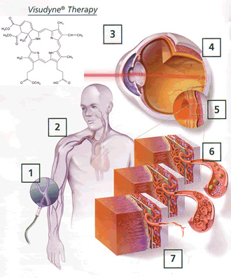 How Visudyne (verteporfin) works. Click to Enlarge.